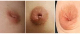 사춘기 유두 비대-미래에 안전하기 위해 어떻게 치료합니까?