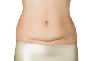 상처에 영향을주지 않도록 제왕 절개 후 해산물을 먹는 데 얼마나 걸립니까?
