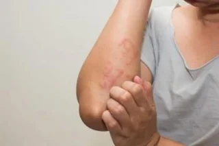 출산 후 손발 가려움증 : 많은 임산부가 위험한 질병의 징후라고 걱정