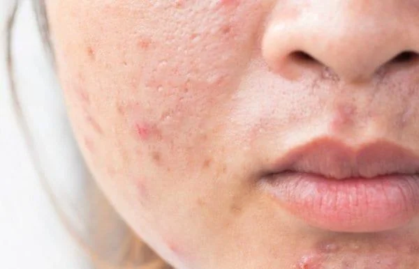 Uso di Sudocrem per le madri