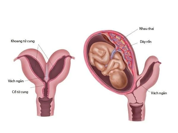 이족 보행 자궁은 생식력에 직접적인 영향을 미치므로 많은 산모가 걱정하게됩니다.