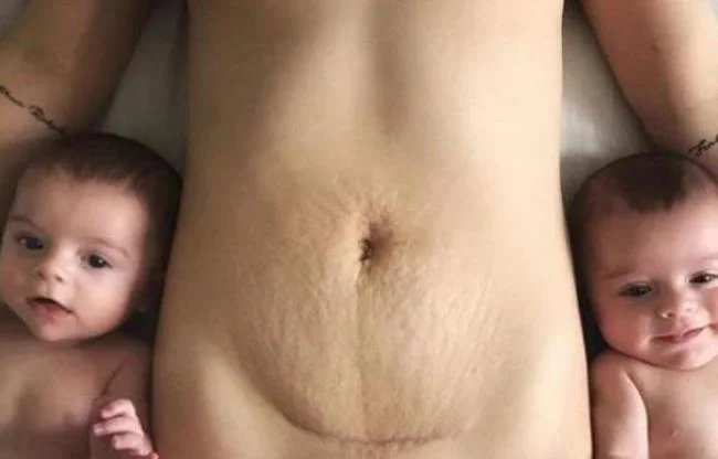 제왕 절개 후 경 복부-원인과 치료법은 무엇입니까?