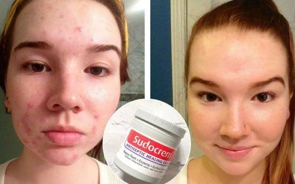 Sudocrem - Nicht nur gegen Babywindelausschlag, sondern hat auch eine großartige Wirkung!