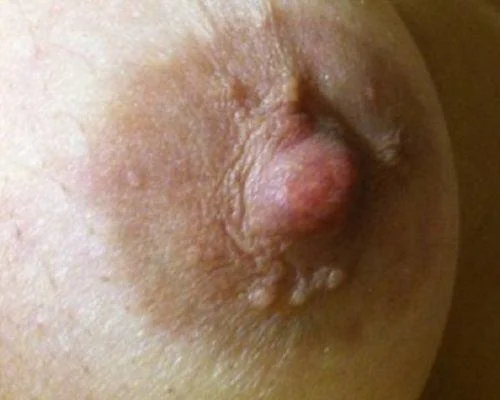임신 중에 나타나는 젖꼭지 주변의 작은 결절은 무엇입니까?