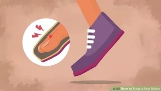 Cómo tratar las ampollas en los pies al caminar mucho y usar zapatos ajustados