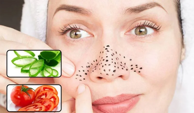 How to treat blackheads at home